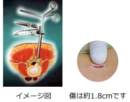 内視鏡下椎間板ヘルニア切除術（MED法） イメージ