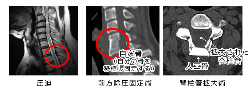 頚椎症性神経根症・脊髄症（頚髄症）の手術