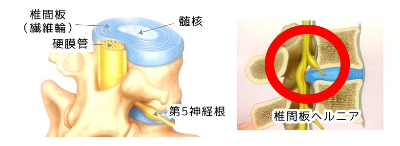 椎間板ヘルニアの断面図